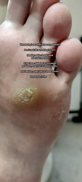 Prevention is the 🗝️ Don't wait till something hurts! #podiatry #prevention #fyp #foothealth #foothealthcare 