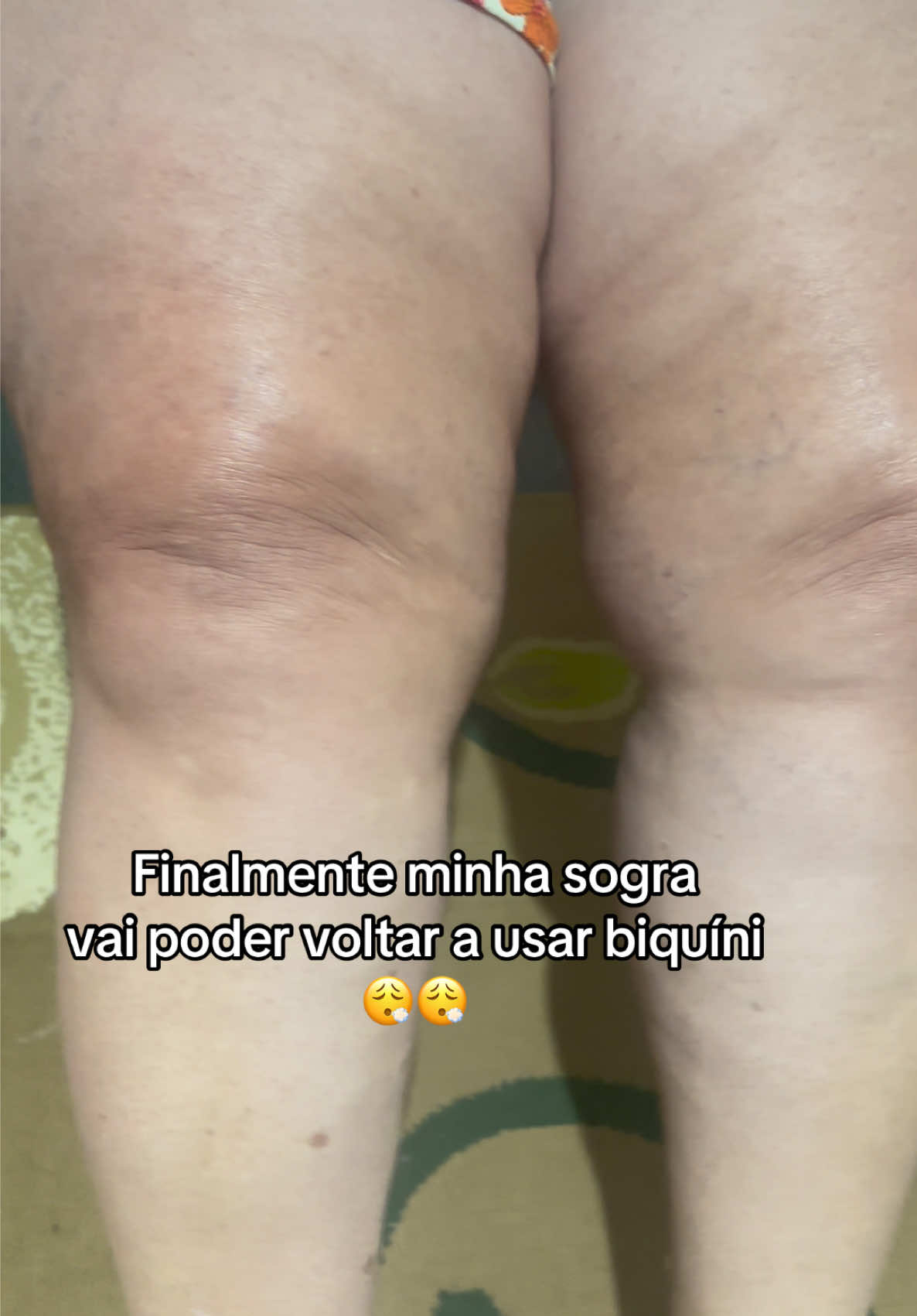 Sem acreditar ainda 😢 #fypシ゚ #tiktokshop #cremerosa #lipedema #estrias 