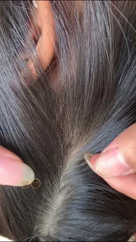 😱#liceremoval 