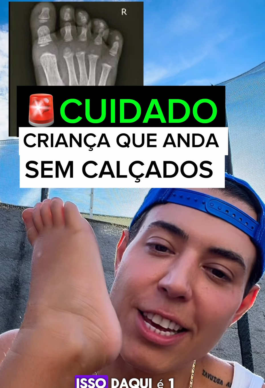 🚨CUIDADO COM EXCESSO DE CALÇADOS NAS CRIANÇAS, PRINCIPALMENTE QUANDO ELAS COMEÇAM A ANDAR. #criança #medicina #pedalar #medico #emagrecimento   