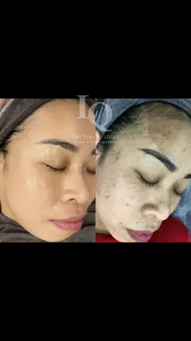 Cập nhập da khách #chamsocdamun#chamsocdanam #chamsocseo#lequynhspa#hocnghespa