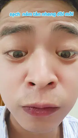 kêu k sạch nào #nam #skincare #lamdep #dieutrimun #nám_tàn_nhang_mụn_thâm 
