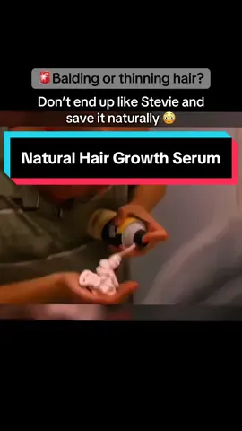 Don’t end up like Stevie shaving your head! If you’re worried about hair loss, try this Be Bodywise Hair Growth Serum Roll On. A natural hair growth treatment designed to stimulate you scalp and support a healthy environment. Start your hair growth journey before it’s too late! #hairgrowth #hairthinning #hairloss #balding #bebodywise 