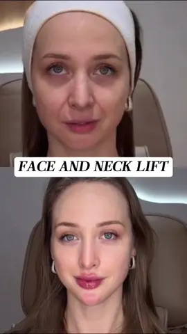 Girls, I almost cried 😭 The difference SMAS Lift made… Before: tired eyes, deep lines, outline gone. After: skin lifted, smooth, jawline clear — I literally gasped at my reflection 🤯 It’s like another version of me walked out of the mirror ✨ #GlowUpJourney #ConfidenceUnlocked #BeautyGlow #YouthfulVibes #BeautyTrends #SMASLift #FacialPlan #FacialEnhancement #FacialDesign #FacialRejuvenation #FacialGlowUp #ShanghaiBeauty #ShanghaiGlow #ShanghaiPlasticSurgery #ShanghaiMedicalBeauty #WelcomeToShanghai #ChinaShanghaiBeauty #ShanghaiClinic #ShanghaiAesthetic #Women35Plus #BeautyTalks #maturebeauty 