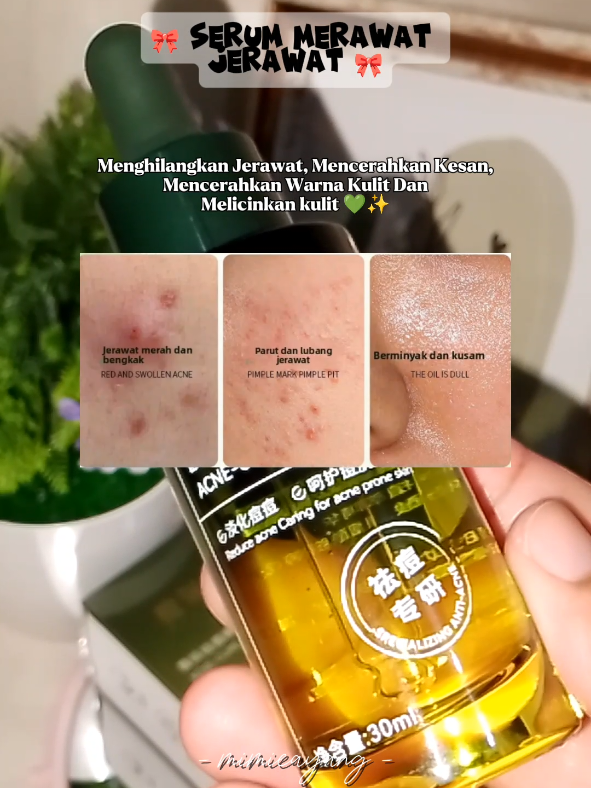 Menghilangkan Jerawat, Mencerahkan Kesan, melicinkan kulit, Mencerahkan Warna Kulit ✅✨ #serum #serumantijerawat #serumjerawat #fyp #fyppppppppppppppppppppppp 