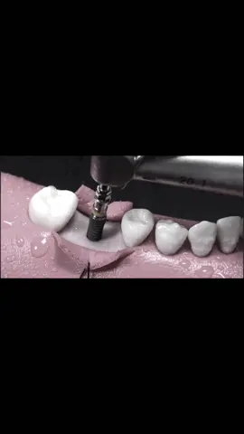 Implant trên mô hình #răng_sứ_thẩm_mỹ #nhakhoa #xuhuong #trending 