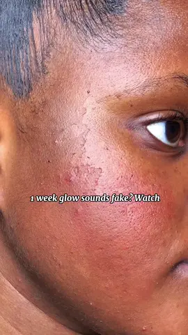 345 Relief cream to the rescue 😍 @Dr.Althea US  #dralthea #345cream #goviral #fyp #acne 