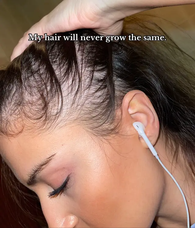 #hairloss #hairtok #hairstyle #hairlosssolutions 
