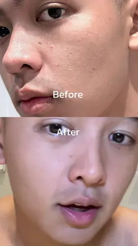 ใครมีรอยสิวรูขุมขนกว้างต้องลองตัวนี้เลย#SkintificTH 