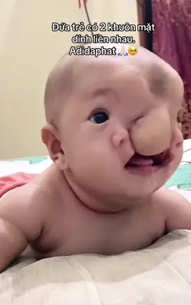 #treem #khuyettat #nghilucsong #fyp #xh 