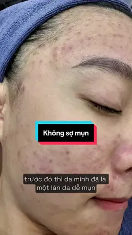 - Mấy con mụn vớ vẩn hong có tuổi với ẻm luôn 🥰  #beuacnes #skincare #kemmunbeuacnes