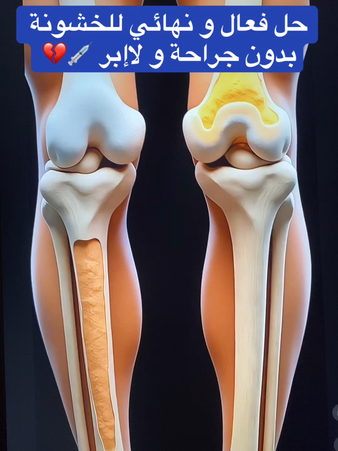 #خشونة_الفقرات #خشونة_مفاصل_الركبة #اليوم_الوطني_السعودي_٩٤ #السعودية #الرياض_الان_ #خشونة_المفاصل #اليوم_الوطني_السعودي_94 #المدينة_المنورة #اليوم_الوطني #عرق_النسا #جدة_الان
