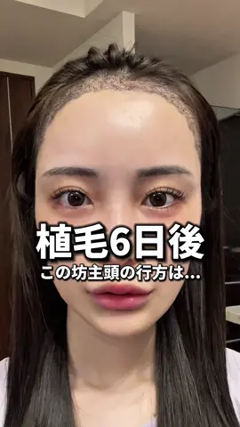 この坊主頭の行方は...#植毛 #整形 #おすすめにのりたい 