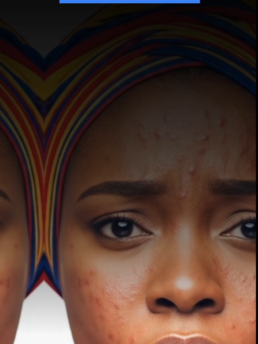 As-tu de l'acné? Ceci peut t'intéresser La crème anti-acné soigne, traite et protège ta peau en profondeur. Partage ton expérience avec nous en commentaire ou tague quelqu’un qui en a besoin ! #Monganga #confianceensoi #soinsdevisage #protectiondelapeau #antiacne #routinepeau #peausaine