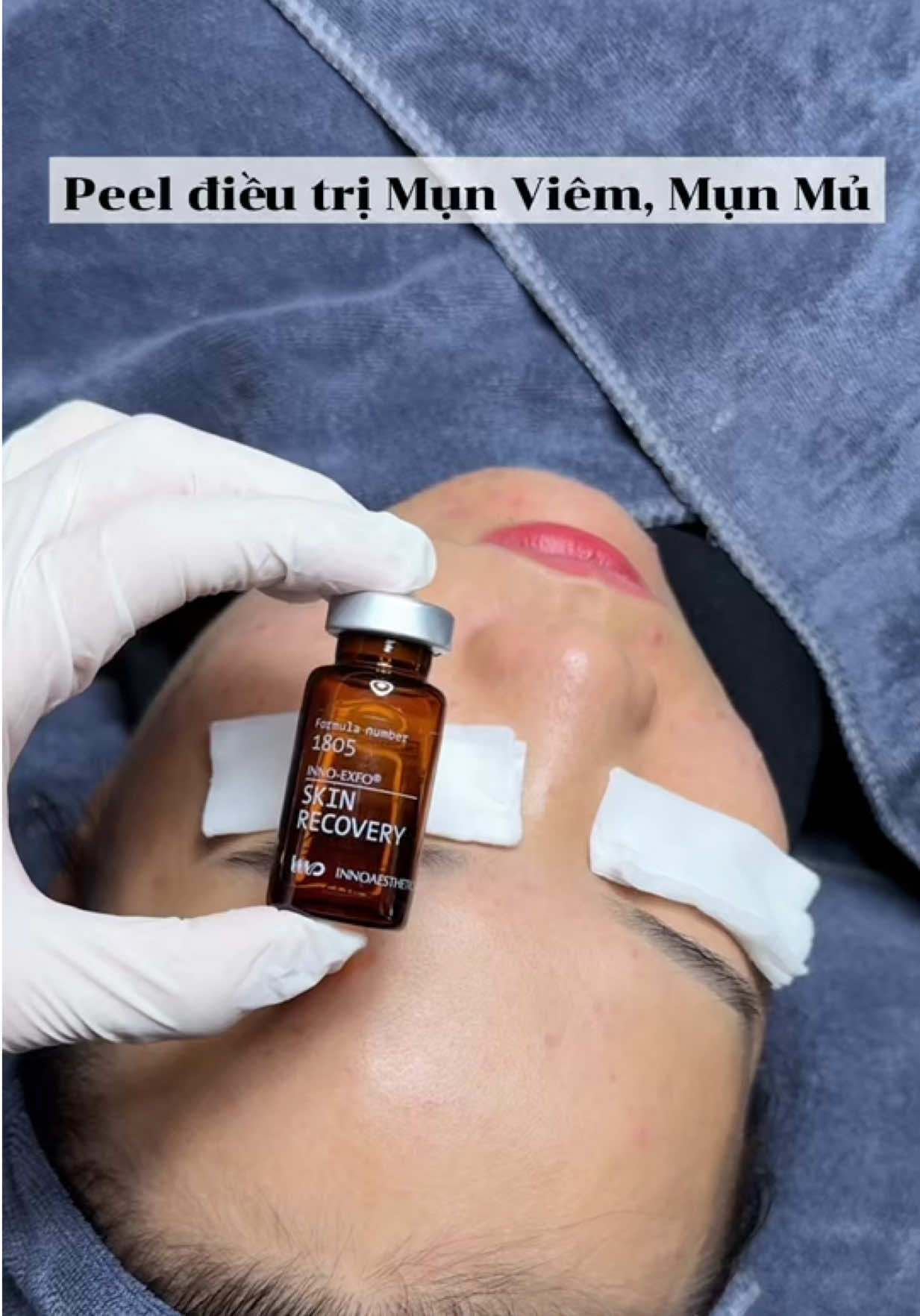 📌Không cần makeup che khuyết điểm 🎭 – vì bạn xứng đáng có làn da mịn màng tự nhiên 🌸 📌Peel Skin Recovery giúp trị mụn từ gốc, phục hồi da khỏe, sáng và đều màu. 👉 Kết quả thấy rõ chỉ sau 1 buổi Peel❣️ 📩 IB em ngay để được tư vấn và book lịch trải nghiệm – chậm là hết slot đó nha!🤗 ___𝐍𝐠𝐨̣𝐜 𝐀́𝐧𝐡 𝐁𝐞𝐚𝐮𝐭𝐲 𝐒𝐤𝐢𝐧𝐥𝐚𝐛___   🏠 𝐃𝐢𝐧𝐡 𝐏𝐡𝐮̛𝐨̛̣𝐧𝐠 - 𝐍𝐠𝐡𝐢̃𝐚 𝐗𝐮𝐚̂𝐧 - 𝐐𝐮𝐲̀ 𝐇𝐨̛̣𝐩 - 𝐍𝐠𝐡𝐞̣̂ 𝐀𝐧  📞𝐇𝐨𝐭𝐥𝐢𝐧𝐞: 𝟎𝟗𝟔𝟓𝟎𝟖𝟔𝟗𝟏𝟗 - 𝟎𝟑𝟕𝟐𝟗𝟕𝟎𝟑𝟑𝟓  #peeldasinhhoc #dieutridachuanykhoa #duocmypham 
