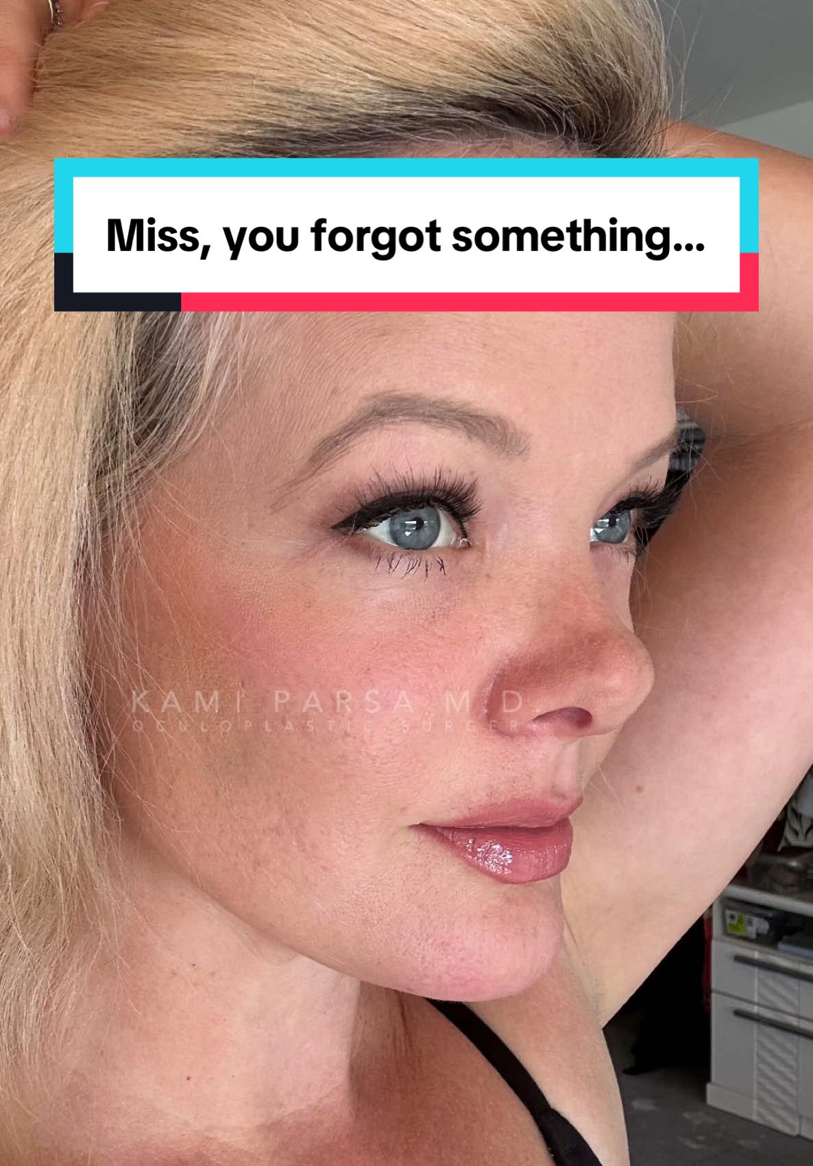 Trifecta Lift = lower blepharoplasty, fat transfer to mid-face, skin tightening. 📍Beverly Hills, CA #eyemakeup #darkcircles #eyebags #kamiparsamd #puffyeyes 