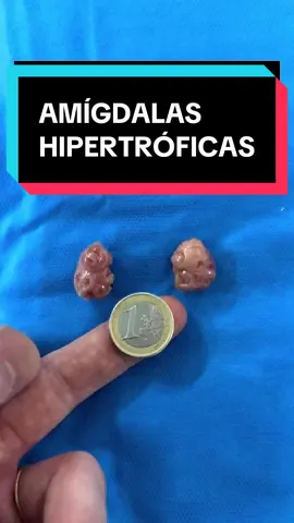 SÍGUEME SI QUIERES MEJORAR TU SALUD Y LA DE TU FAMILIA. Amígdalas hipertróficas o las anginas de toda la vida. Pueden hacer que tu hijo no respire bien, no coma, no duerma, tenga malformaciones en los dientes o incluso afectar a su neurodesarrollo. Cuando operamos a un niño que lo necesita los padres nos suelen decir: “¡Qué cambio! Es otro niño para mejor” #anginas #niños #dormir #comer #padres
