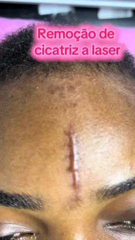 ✨ A tecnologia a laser chegou para transformar a sua pele! ✨ Com o tratamento de remoção de cicatrizes a laser, é possível suavizar marcas, estimular o colágeno e devolver à pele uma aparência mais uniforme e saudável. 💫 O resultado? Uma pele renovada, mais lisa e cheia de confiança! 💕 👉 Indicado para cicatrizes de acne, cirúrgicas e traumáticas. 👉 Procedimento seguro e com resultados progressivos. 🔹 Dê adeus às marcas e olá a uma nova versão da sua pele! #Laser #RemoçãoDeCicatrizes #EstéticaAvançada #MilVibrações #PelePerfeita  