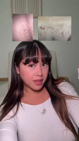 PSA GIRLIES 🤩 #peachslices #ingrownhairtreatment #womenshealth #smoothingsolution #ttshop 