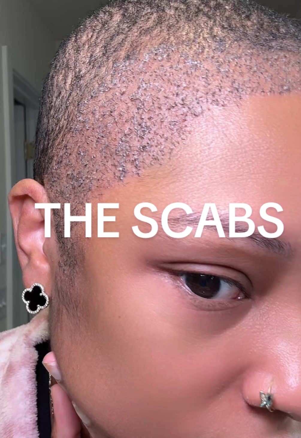 After the 1st session I still had scabs hanging on 😭 I was afraid of pulling the follicles out. #femalehairtransplant #hairtransplant #hairtransplantturkey #hairtransplantjourney #tractionalopecia 