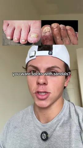 You don't have to feel embarrassed of your toes! #LanguageLearning #lunavia #antifungaltreatment #antifungal #toefungus 