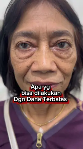 #eyefatremoval #buangkantongmataserpong #buangkantongmatakalimantan #buangkantongmatajakarta #CapCut 