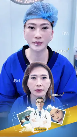 Kombinasi pembesaran dagu dan pengencangan mata untuk saudari Indonesia#facelift #chin #fypシ゚ #fyppppppppppppppppppppppp #dagu 