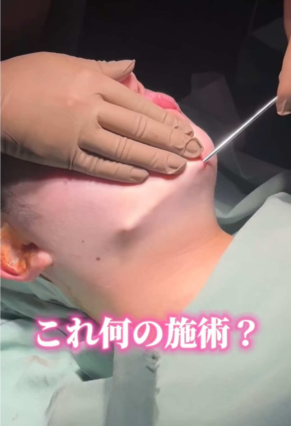 これ何の施術？#小顔整形 #整形 #脂肪吸引 