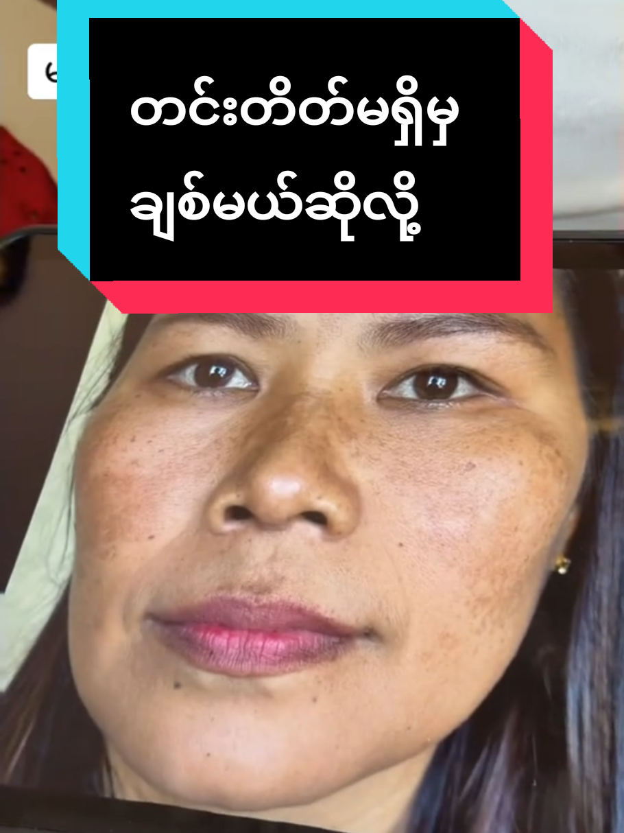 #တင်းတိတ်အမဲစက်အတွက် #တင်းတိတ်ပျောက်ချင်သူများအတွက် #HCအမာရွတ်ပျောက်တင်းတိတ်ပျောက်ဆေးမှုန့် #တစ်လစာ၃ထုပ်ပဲသုံးပေး #foryoupage @Ko Wai Yan @Ko Wai Yan @Ko Wai Yan 