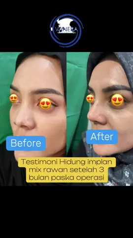 Hidung tegas dan mancung natural sesuai anatomi hidung dan aman😍❤️‍🔥 #mancunginstant#rhinoplasty#operasihidung#implanhidung#klinikbedahplastik 