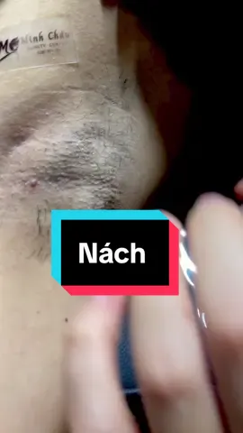 Khi cạo lông nên cạo theo chiều lông mọc và cạo nhẹ nhàng cẩn thận đối với những chỗ bị nổi mụn, sưng viêm nha  #trietlong #trietlongvinhvien #chamsocda #spa #trietlongnach