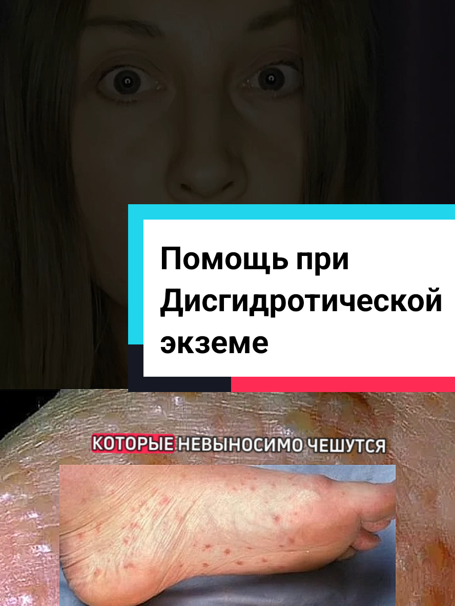 Ответ пользователю @yliashka17 Что может помочь при  Дисгидротической экземе. #экзема #атопическийдерматит #синдромотменыгормонов #дисгидротическаяэкзема #аллергия 