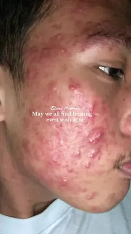 It’s a sign — your clear-skin journey starts here.🤍✨  #fyp #ellanaminerals #ellanaclearskinclarifyingserum #ellanaazelaicacid #ellanaserum         