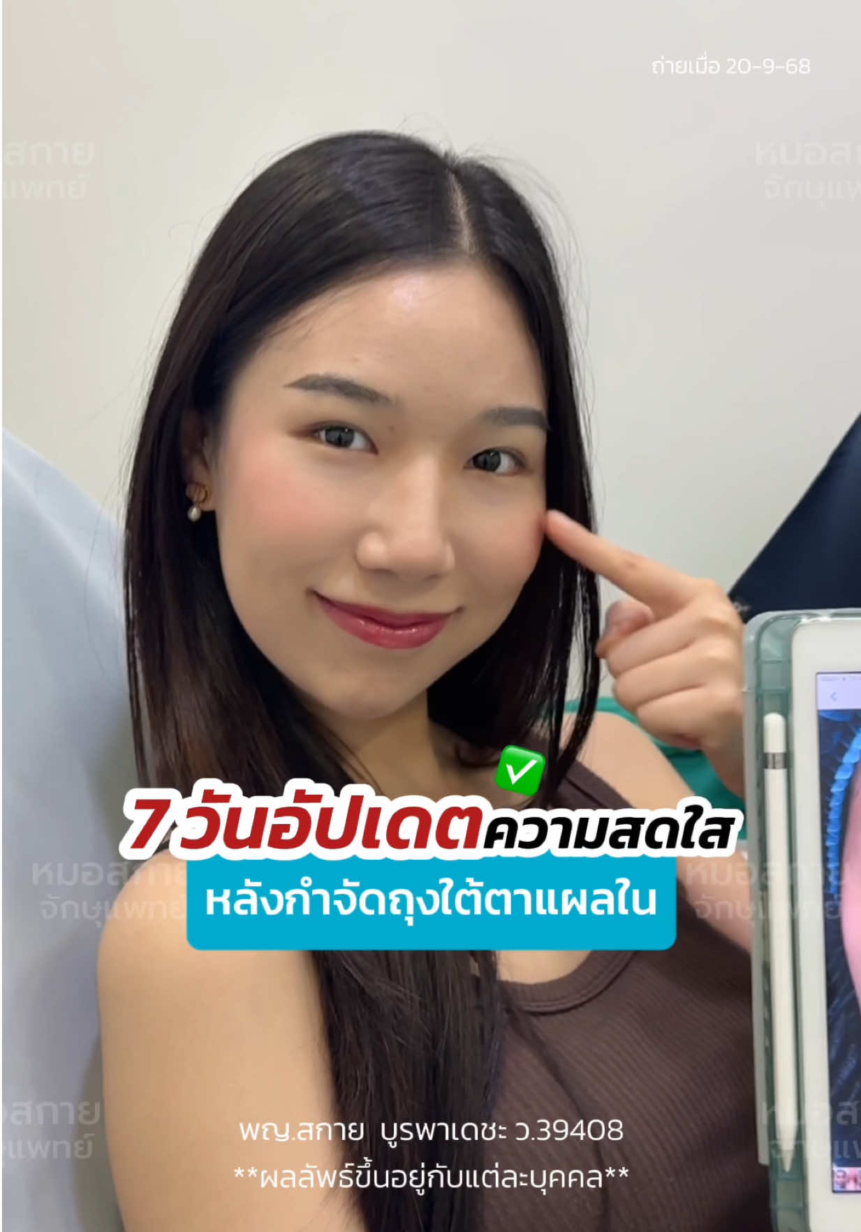 7 อัปเดตความสดใส✨ หลัง #กำจัดถุงใต้ตาแผลใน  #ถุงใต้ตา #หมอสกาย #สกายคลินิก #skyclinic_drsky