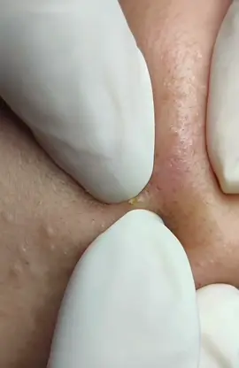 Mụn ẩn lấp la lấp ló🤣#mụn #dieutrimun #nanmun 