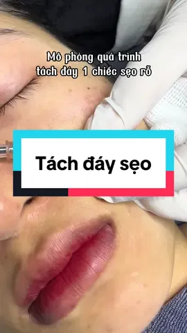 Tách đáy - 1 pp lâu cũ nhưng không có gì phải bàn cãi về hiệu quả trị sẹo rỗ. Tuy nhiên, để đạt kết quả cao nhất nên kết hợp thêm nhiều phương pháp khác nữa #triseo #bslydalieu 