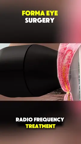 Forma Eye Surgery (3D Animation) #forma #eyes #surgery #feel #3danimation 
