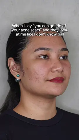 Dealing with acne scars? You’re in the right hands 💙 Book your consultation today—send us a DM 💌 #RemedySkinSolutions #acne #acnescars #acnetreatment #fyp