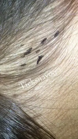 Remove lice #omg😱😱😱 #lice😰😰😰 #😭😭😭 #tripofobia😮😥 #liceremoval 