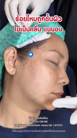 ดึงไหมแบบพอดี เน้นกระจายแนวแรงเส้นไหม  #ร้อยไหม #ยกกระชับ #หน้าเรียว #fyp 