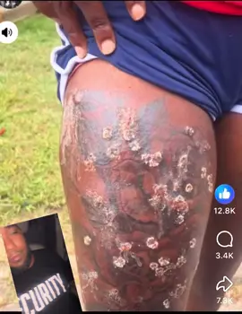 When your local tattoo artist tells you he got a deal #HellNo #IWouldNever #FYP #Infection 