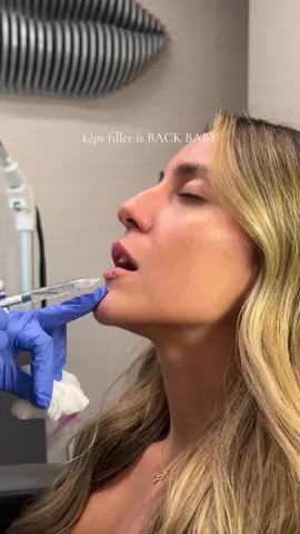Lips are in , filler is back #fillerblindness 