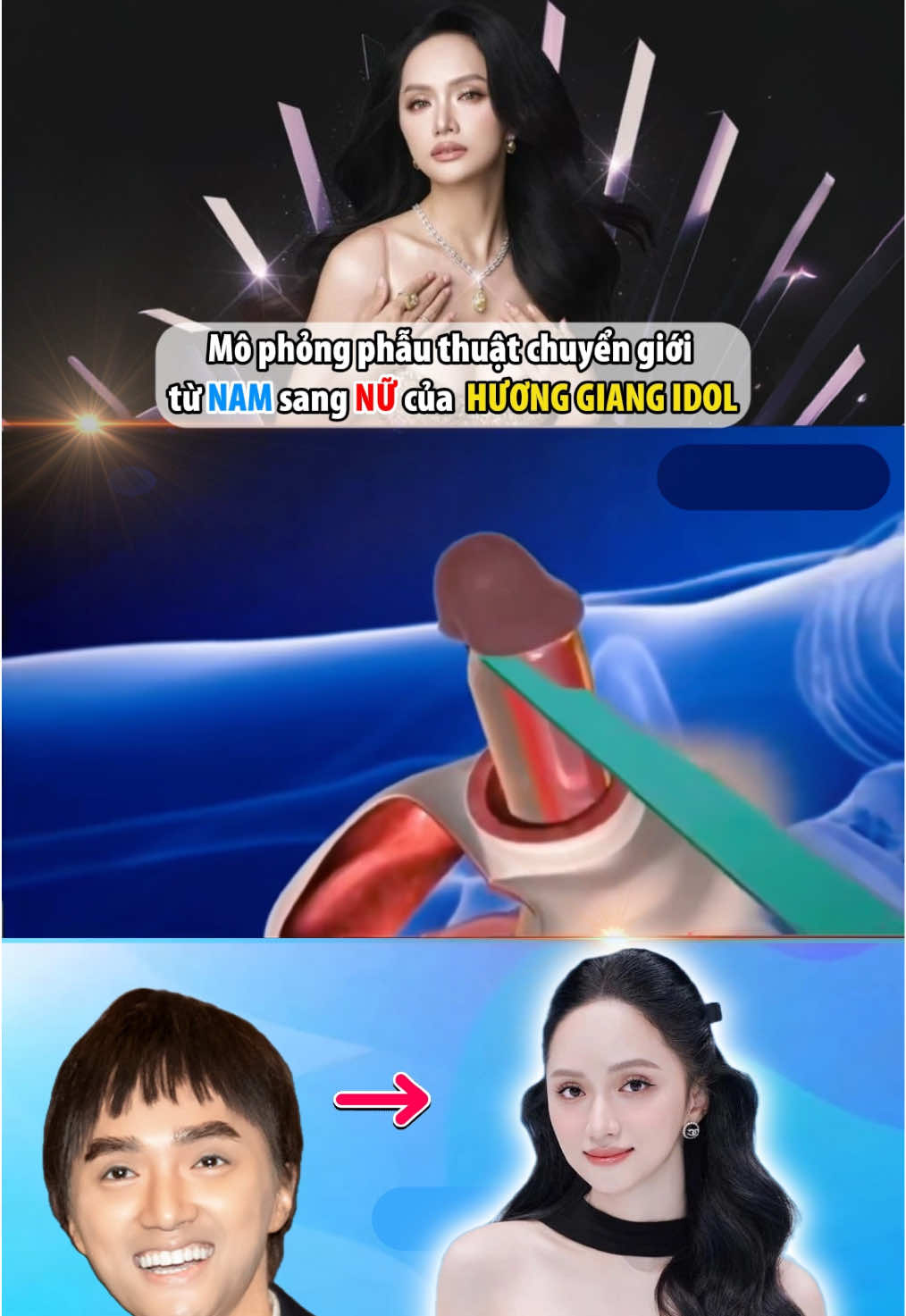 Hương Gianh Idol phẫu thuật từ nam sang nữ như thế nào nhỉ? Xem hết vid luền nhé… #huonggiangidol #missuniverse #phunu #benhtinhduc #sinhly 