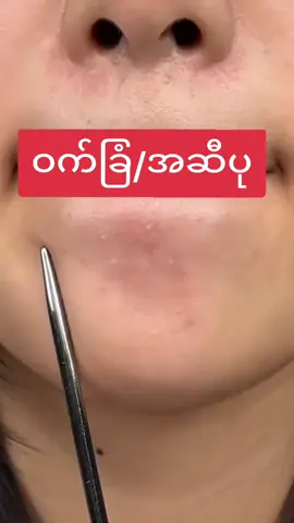 #Hcသလဲသီးမျက်နှာသစ်ဆပ်ပြာ #ဝက်ခြံပျောက်ချင်သူများအတွက် #Viber09799426419 #လက်လီလက်ကားဝယ်ယူအားပေးလို့ရပါတယ်ရှင့် 