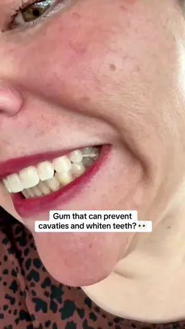 I’m literally chewing my dentist right now—this Larineco remineralizing gum is packed with enamel-strengthening ingredients that help fight cavities after every meal. Fresh breath + healthier teeth = the easiest upgrade to your daily routine. #remineralizinggum #oralhealthtips #cavityprevention #dentalcarehacks #healthysmile 