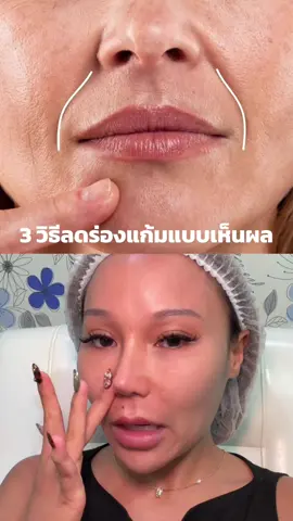 ร่องแก้มคือจุดที่ทำให้หน้าเราดูมีอายุ แล้วหน้าชั้นกระดูกมันเริ่มทรุดแล้วทุกคน ตอนนี้เลยต้องทำทั้งฟิลเลอร์แล้วใช้อัลเทอร่าช่วยยก ✨ ✅ ใครอยากแก้ร่องแก้มลองไปปรึกษาหมอปิ๊กได้นะ พี่หมอเก่งมาก @หมอผิวหนัง proderma  #ร่องแก้ม #ฟิลเลอร์ #ฉีดฟิลเลอร์ #คลินิกเสริมความงาม #ศัลยกรรม 