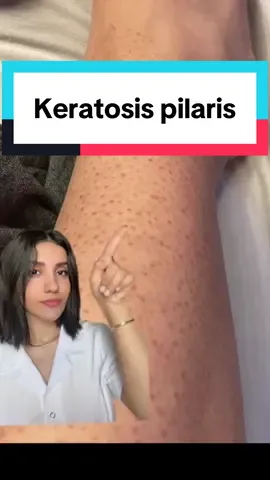 Keratosis pilaris can’t be cured completely, but with consistent care—using gentle cleansing, daily moisturizers with lactic acid, urea, or salicylic acid, and avoiding harsh scrubbing—you can keep the bumps and roughness under control. Patience is key, since results usually show after several weeks of regular treatment. #keratosispilaris #chickenskin #kp 