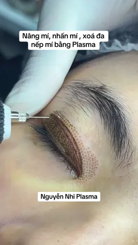 Nâng mí , nhân mí bằng Plasma #plasma #plasmafibroblast #nhấn_mí_không_xâm_lấn_plasma #Nângmíkophẫuthuật #Nângmikhongphauthuat 
