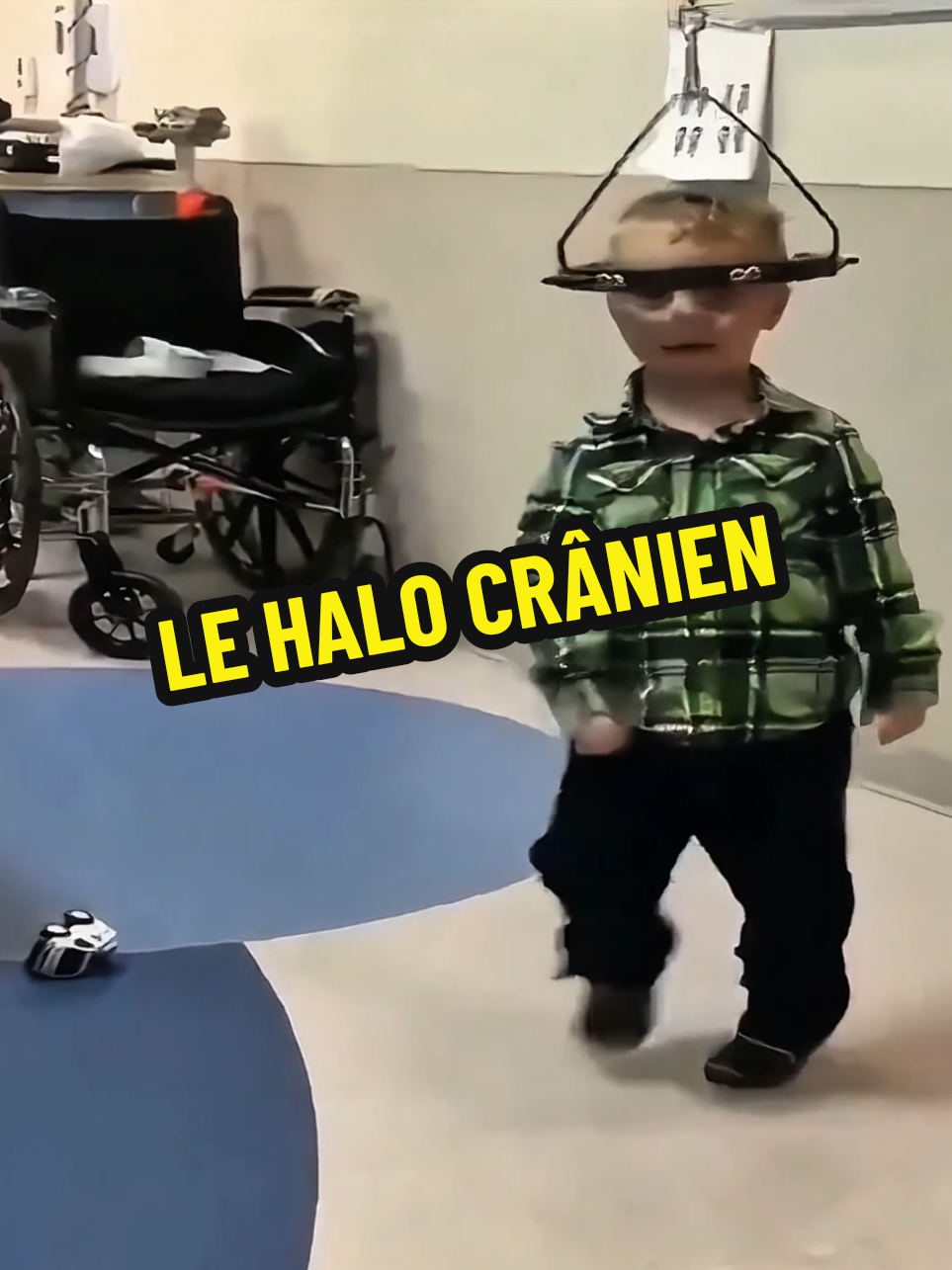 Le halo crânien est un moyen efficace d'appliquer une traction cervicale. L'anneau étant fixé au crâne par plusieurs broches, la pression sur chaque broche est réduite. Par conséquent, une grande traction peut être appliquée pendant une longue période. #Halo #crane #scoliosis #pourtoii #LIVEIncentiveProgram 