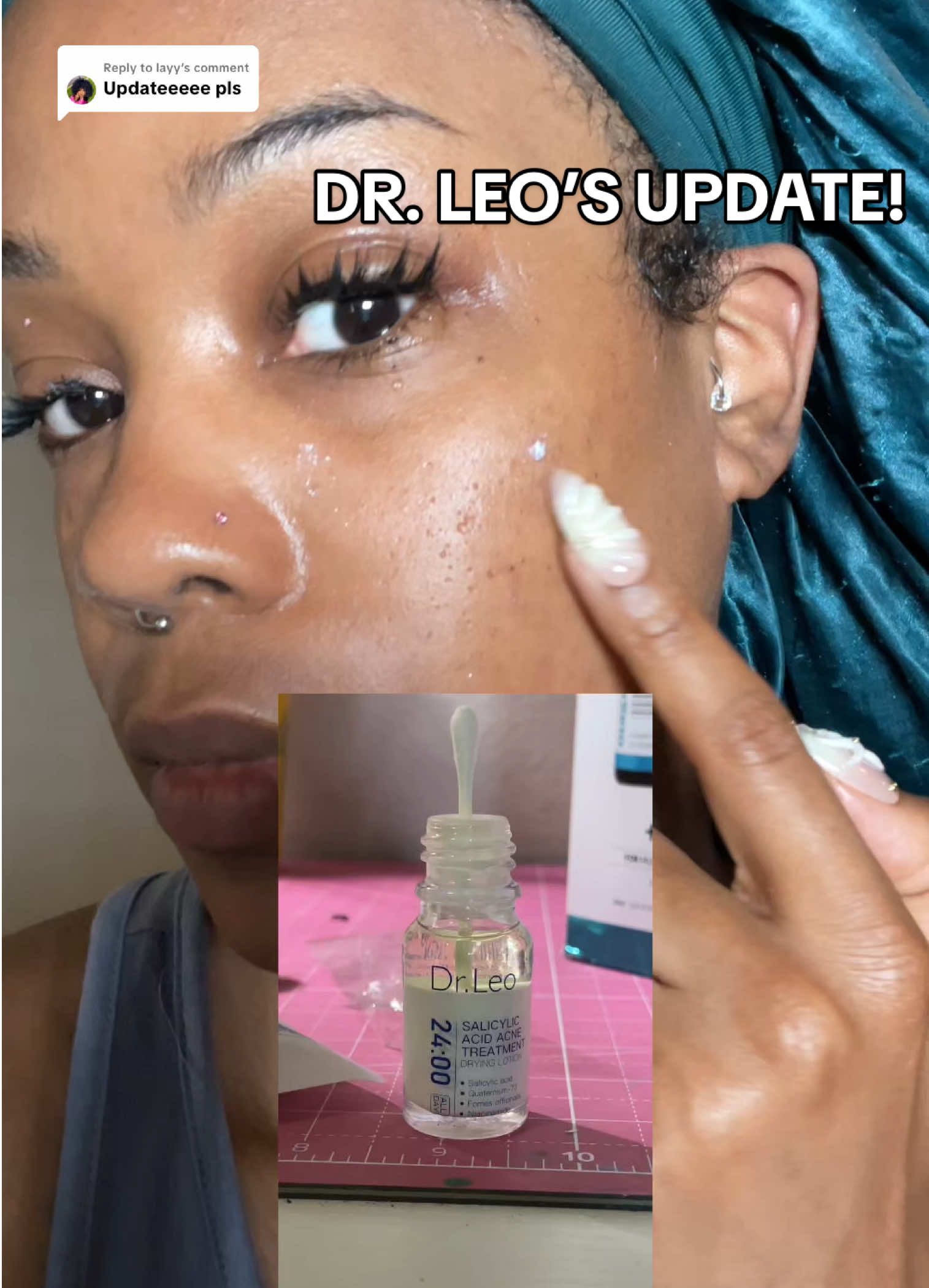 Replying to @layy it definitely works 🥹🙏🏽 #acnetips #acnetreatment #acneskincare #acne #drleo 